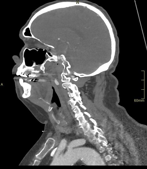 Basilar artery aneurysm (Radiopaedia 56261-62932 C 40).jpg