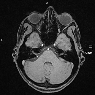 Basilar artery perforator aneurysm (Radiopaedia 82455-99523 F 30).jpg