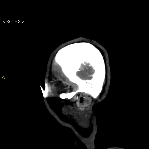 Basilar artery thrombosis (Radiopaedia 16260-15944 C 2).jpg