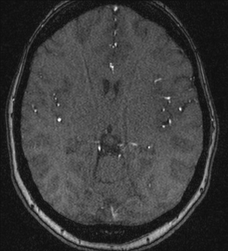 File:Basilar tip aneurysm (Radiopaedia 26504-26632 MRA 125).jpg