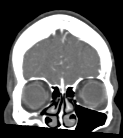 Basilar tip aneurysm with coiling (Radiopaedia 53912-60086 B 18).jpg