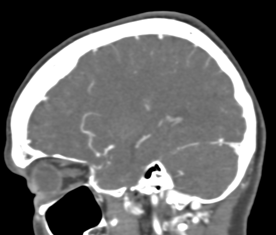 Basilar tip aneurysm with coiling (Radiopaedia 53912-60086 C 37).jpg