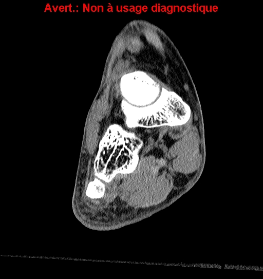 Baxter neuropathy (Radiopaedia 25988-26125 Coronal non-contrast 1).jpg