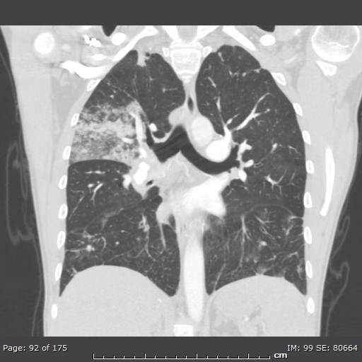 Behçet disease (Radiopaedia 44247-47889 Coronal lung window 27).jpg