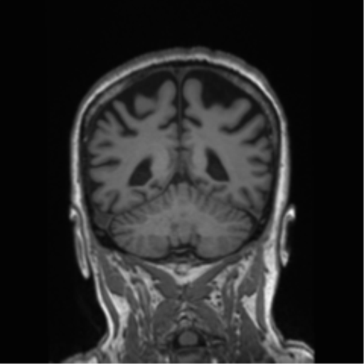 Behavioral variant frontotemporal dementia and late onset schizophrenia (Radiopaedia 52197-58083 Coronal T1 33).png