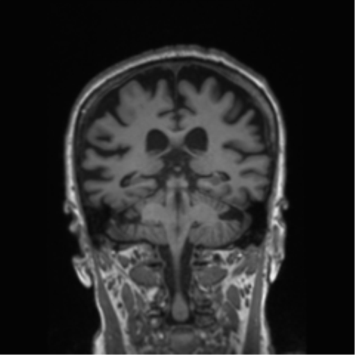 Behavioral variant frontotemporal dementia and late onset schizophrenia (Radiopaedia 52197-58083 Coronal T1 40).png