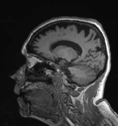 Behavioral variant frontotemporal dementia and late onset schizophrenia (Radiopaedia 52197-58083 Sagittal T1 33).png