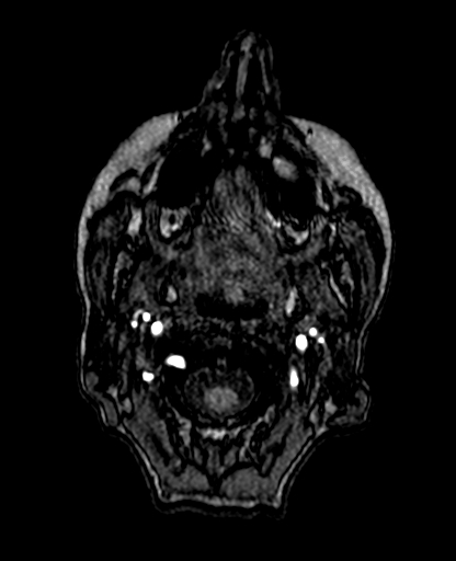 Berry aneurysm of the terminal internal carotid artery (Radiopaedia 88286-104918 Axial TOF 8).jpg