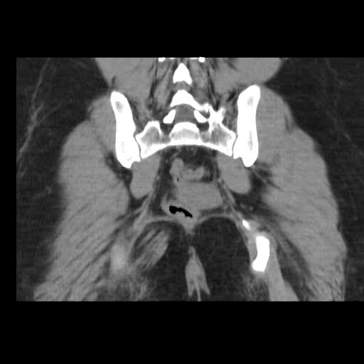 File:Bicornuate uterus- on MRI (Radiopaedia 49206-54296 Coronal non-contrast 18).jpg