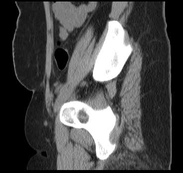 File:Bicornuate uterus (MRI) (Radiopaedia 49206-54296 Sagittal 14).png