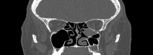 Bilateral Ectopic Infraorbital Nerves (Radiopaedia 49006-54084 Coronal bone window 44).jpg