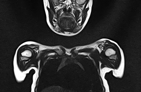 File:Bilateral Sprengel deformity with Klippel-Feil syndrome (Radiopaedia 66395-75650 Coronal T2 5).jpg