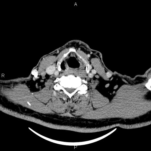 File:Bilateral Warthin tumors (Radiopaedia 84034-99263 Axial With contrast 45).jpg