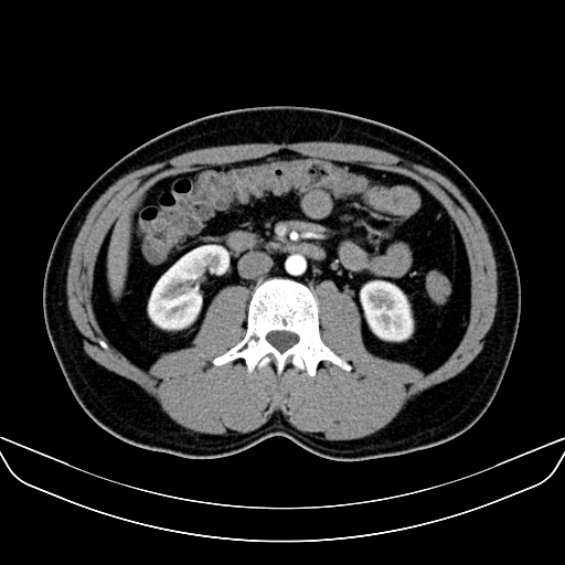 Bilateral accessory renal arteries with mild pelvi-ureteric junction (PUJ) obstruction (Radiopaedia 66357-75596 A 29).jpg