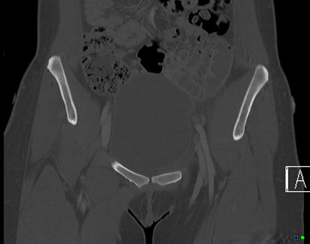File:Bilateral acetabular fractures (Radiopaedia 79272-92308 Coronal bone window 7).jpg