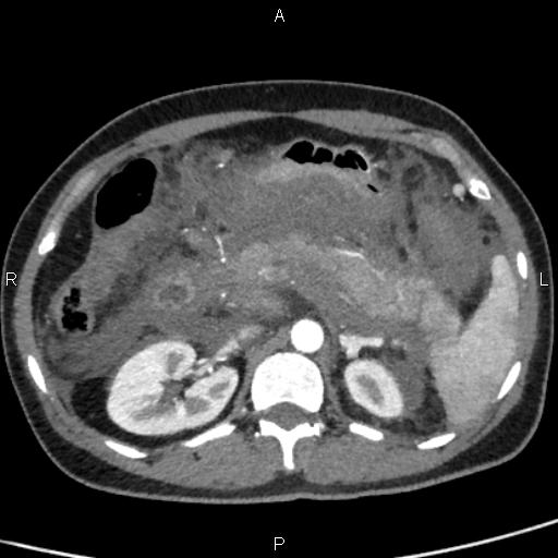 Bilateral adrenal gland hyperenhancement in pancreatitis (Radiopaedia 86642-102753 B 48).jpg