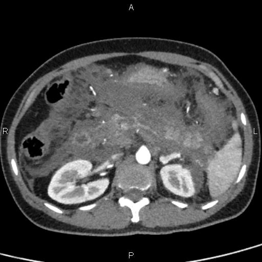 File:Bilateral adrenal gland hyperenhancement in pancreatitis (Radiopaedia 86642-102753 B 51).jpg
