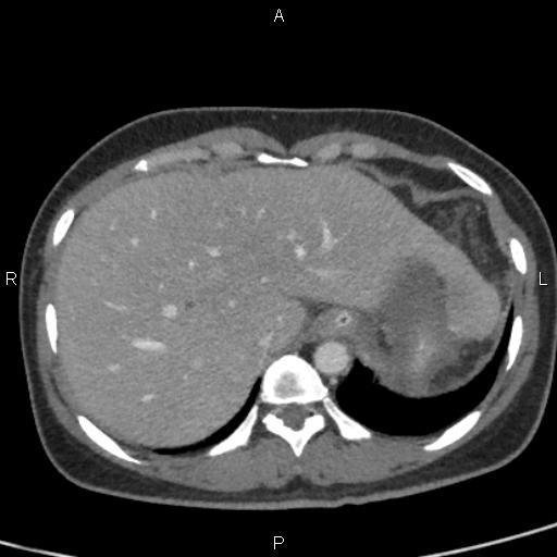 Bilateral adrenal gland hyperenhancement in pancreatitis (Radiopaedia 86642-102753 E 16).jpg