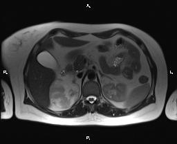 File:Bilateral adrenal myelolipoma (Radiopaedia 63058-71537 Axial T2 14).jpg