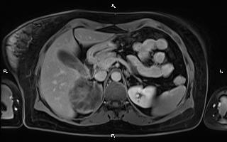 File:Bilateral adrenal myelolipoma (Radiopaedia 63058-71537 H 35).jpg