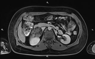File:Bilateral adrenal myelolipoma (Radiopaedia 63058-71537 H 47).jpg