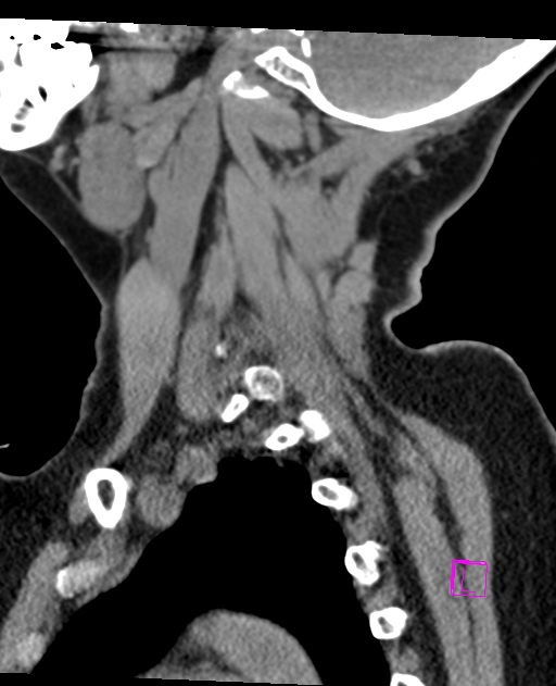 Bilateral atlanto-occipital assimilation (Radiopaedia 28350-28603 D 19).jpg