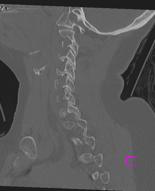Bilateral atlanto-occipital assimilation (Radiopaedia 28350-28603 Sagittal bone window 28).jpg