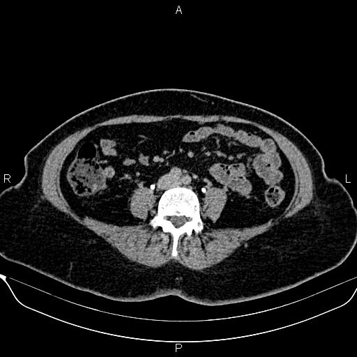 Bilateral benign adrenal adenomas (Radiopaedia 86912-103124 Axial C+ delayed 96).jpg