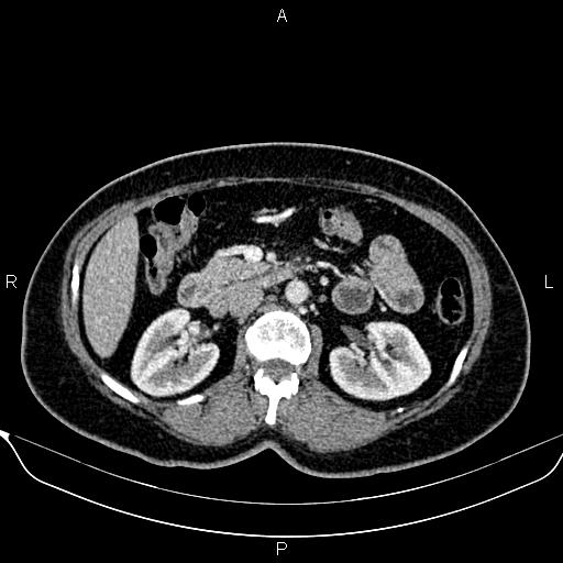 Bilateral benign adrenal adenomas (Radiopaedia 86912-103124 B 46).jpg