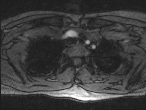Bilateral carotid body tumors and right glomus jugulare tumor (Radiopaedia 20024-20060 Axial MRA 174).jpg