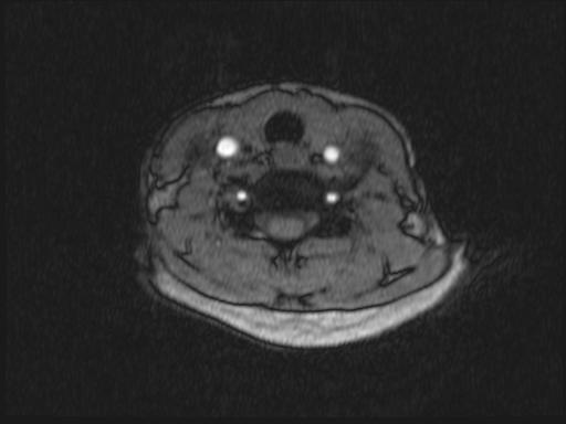 Bilateral carotid body tumors and right glomus jugulare tumor (Radiopaedia 20024-20060 Axial MRA 217).jpg