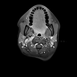 File:Bilateral carotid body tumors and right jugular paraganglioma (Radiopaedia 20024-20060 Axial 101).jpg
