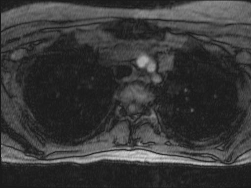 File:Bilateral carotid body tumors and right jugular paraganglioma (Radiopaedia 20024-20060 Axial 273).jpg