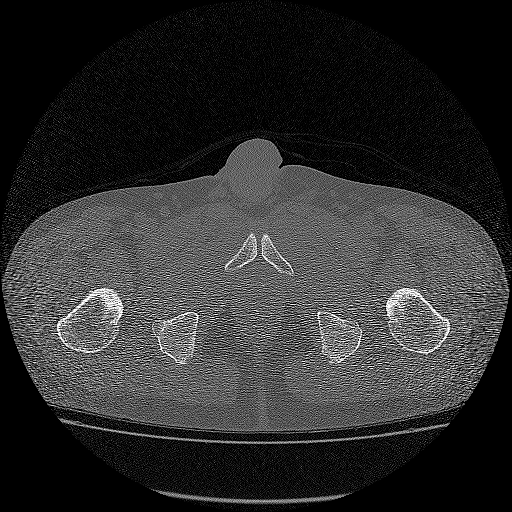 Bilateral femoral neck stress fractures (Radiopaedia 28666-28954 Axial bone window 72).png
