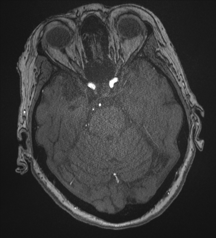 Bilateral fetal posterior communicating arteries (Radiopaedia 41286-44102 Axial MRA 65).png