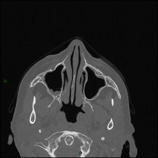 Bilateral frontal mucoceles (Radiopaedia 82352-96454 Axial bone window 202).jpg