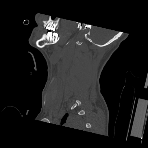 Bilateral locked facets (Radiopaedia 33850-35023 Sagittal bone window 53).png