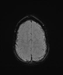 Bilateral mesial temporal polymicrogyria (Radiopaedia 76456-88181 Axial SWI 60).jpg