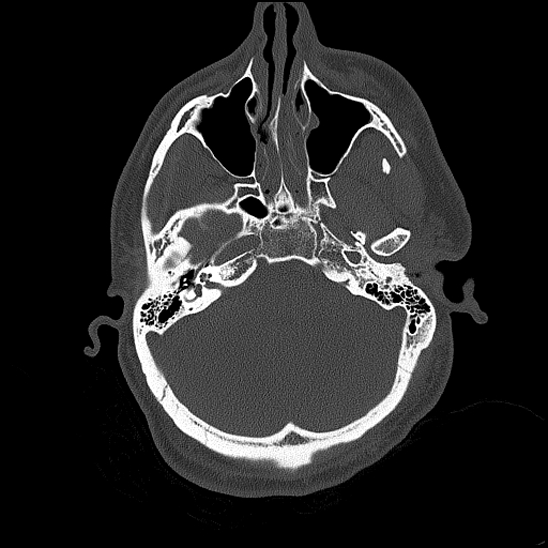 Bilateral occipital condyle fracture (type 2) (Radiopaedia 87675-104089 Axial bone thins 58).jpg