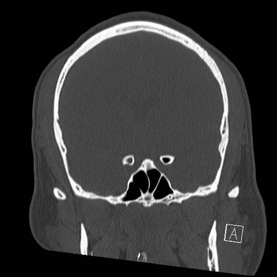 Bilateral occipital condyle fracture (type 2) (Radiopaedia 87675-104089 Coronal bone window 48).jpg