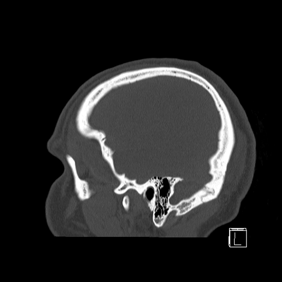 Bilateral occipital condyle fracture (type 2) (Radiopaedia 87675-104089 Sagittal bone window 4).jpg