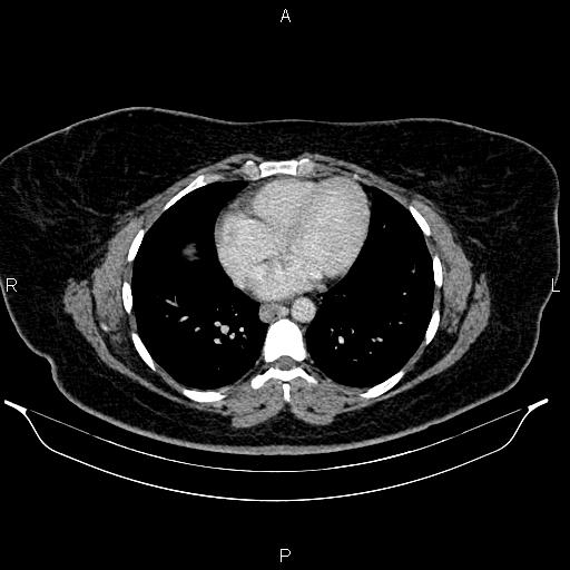 Bilateral ovarian dermoid cysts (Radiopaedia 85785-101603 A 7).jpg