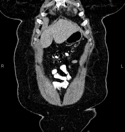 File:Bilateral ovarian dermoid cysts (Radiopaedia 85785-101603 C 2).jpg