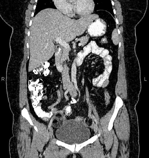 Bilateral ovarian dermoid cysts (Radiopaedia 85785-101603 C 22).jpg
