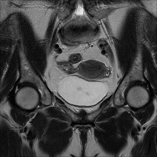 File:Bilateral ovarian dermoid cysts (Radiopaedia 90152-107338 Coronal T2 13).jpg