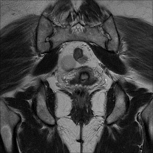 File:Bilateral ovarian dermoid cysts (Radiopaedia 90152-107338 Coronal T2 21).jpg