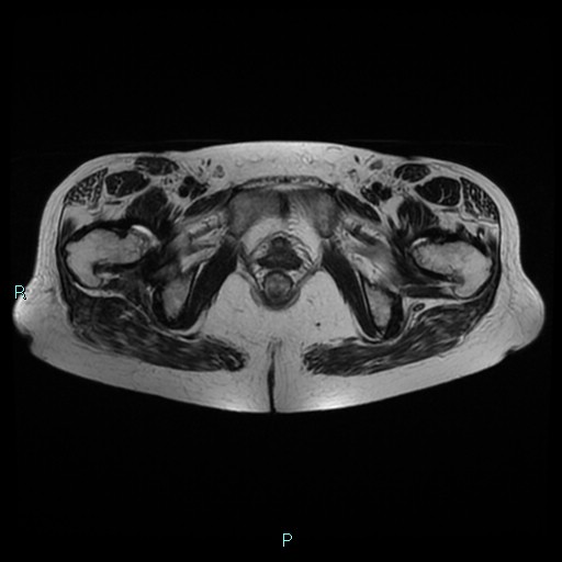 File:Bilateral ovarian fibroma (Radiopaedia 44568-48293 Axial T2 25).jpg