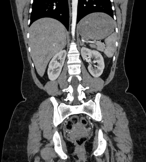 Bilateral ovarian mature cystic teratomas (Radiopaedia 79373-92457 B 61).jpg