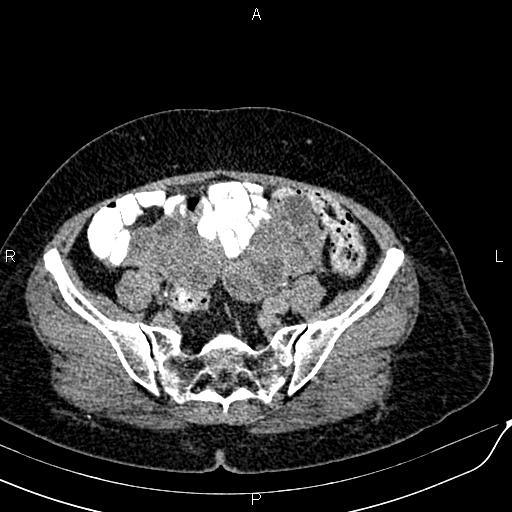 Bilateral ovarian serous cystadenocarcinoma (Radiopaedia 86062-101989 Axial C+ delayed 60).jpg