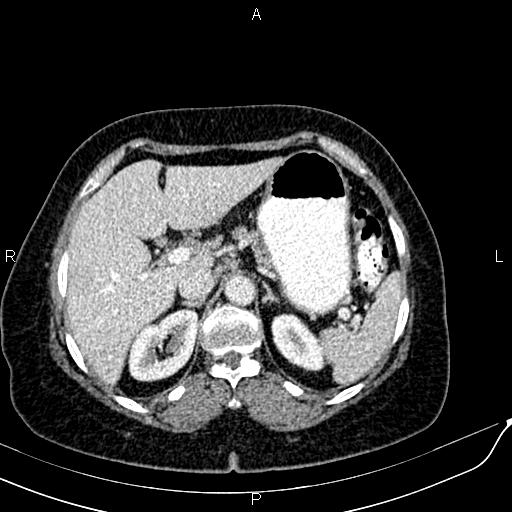 Bilateral ovarian serous cystadenocarcinoma (Radiopaedia 86062-101989 B 27).jpg